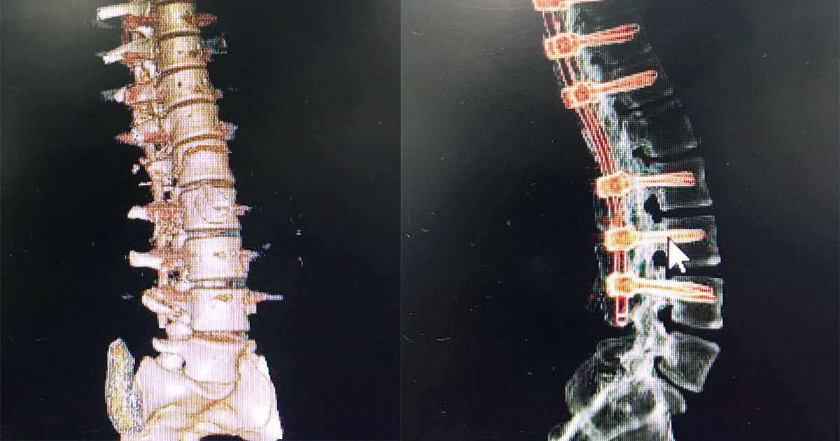 rehabilitacion ortopedica en paciente con trauma raquimedular 2