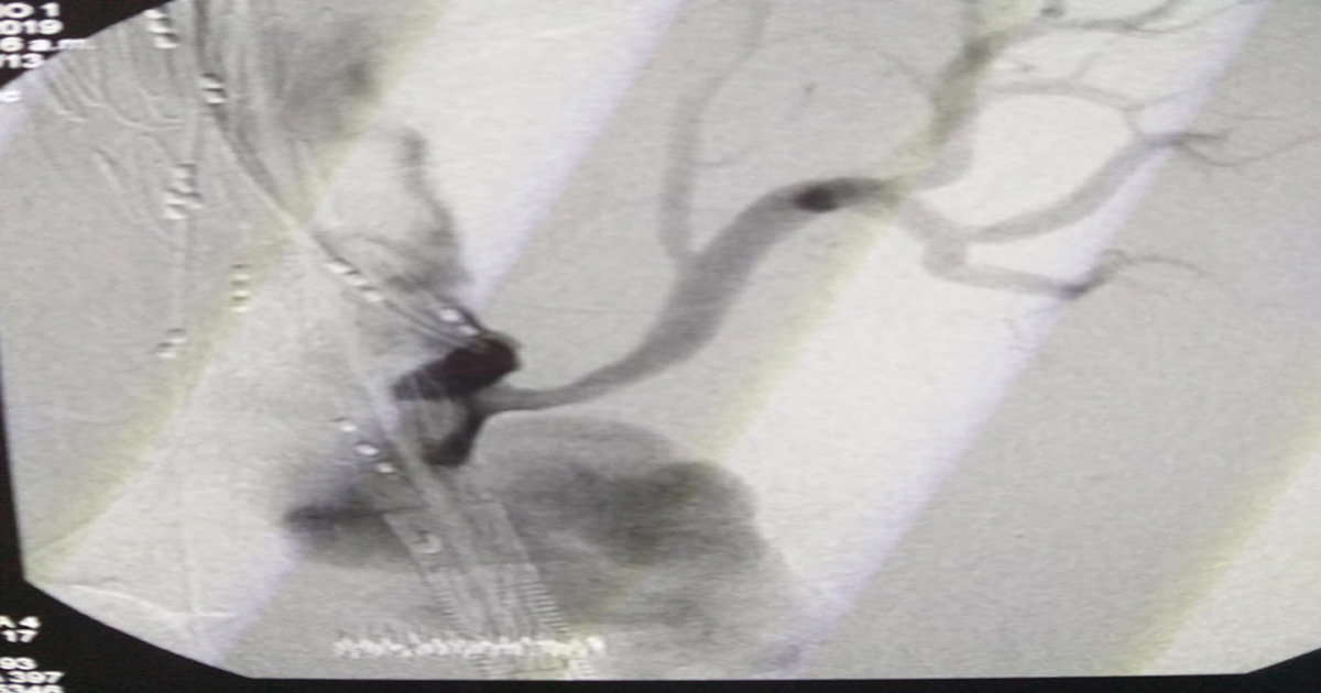 reparo endovascular de aneurisma 2