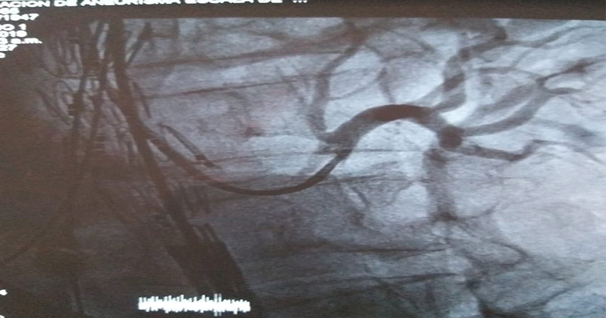 reparo endovascular de aneurisma 3