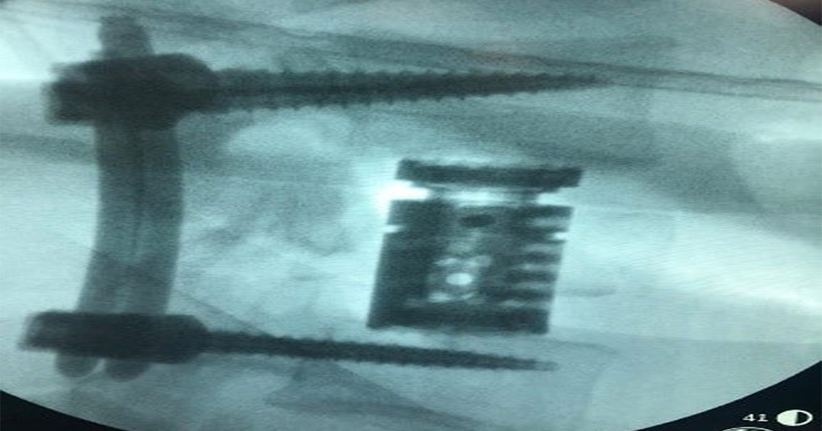 sustitucion-de-cuerpo-vertebral-por-medio-de-cilindro-de-titanio-2