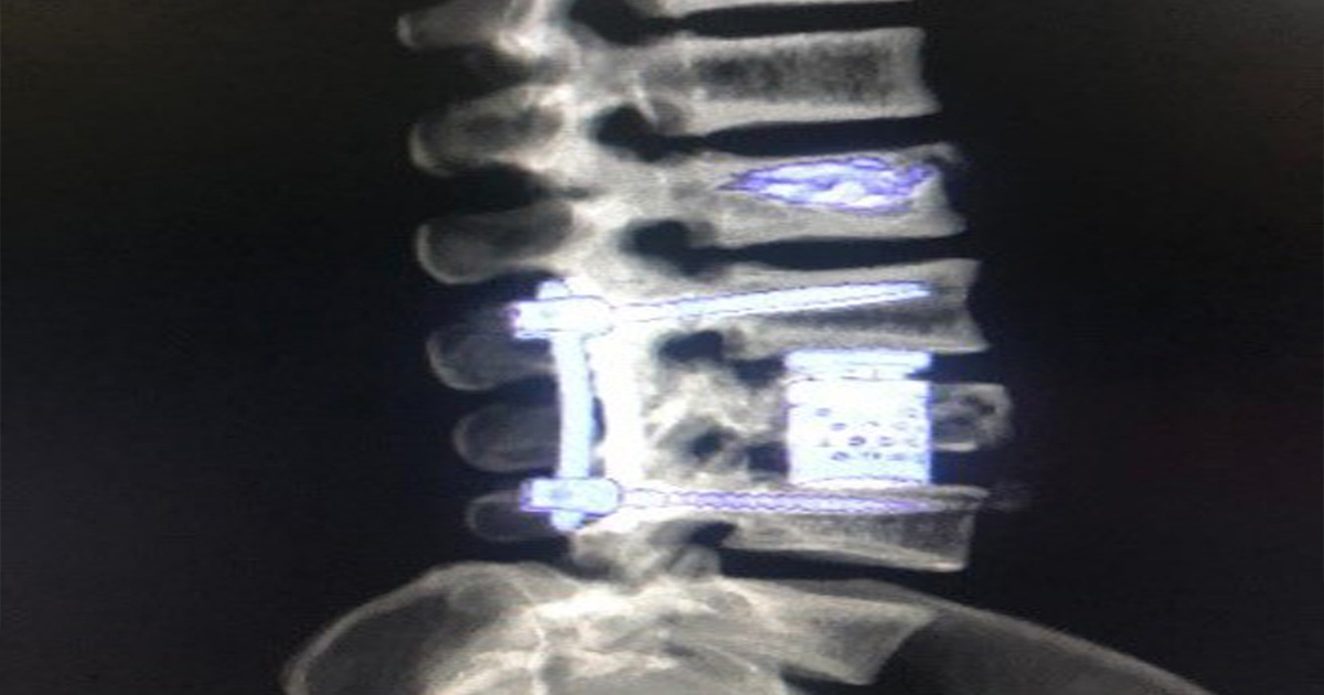 sustitucion-de-cuerpo-vertebral-por-medio-de-cilindro-de-titanio-3