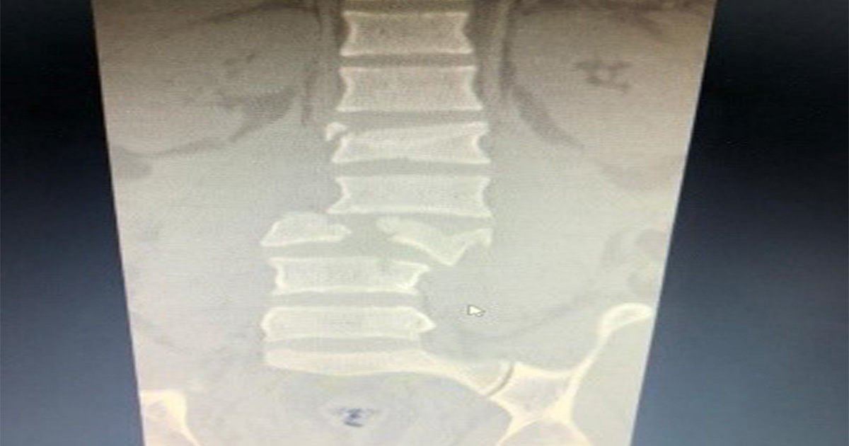 sustitucion-de-cuerpo-vertebral-por-medio-de-cilindro-de-titanio-4