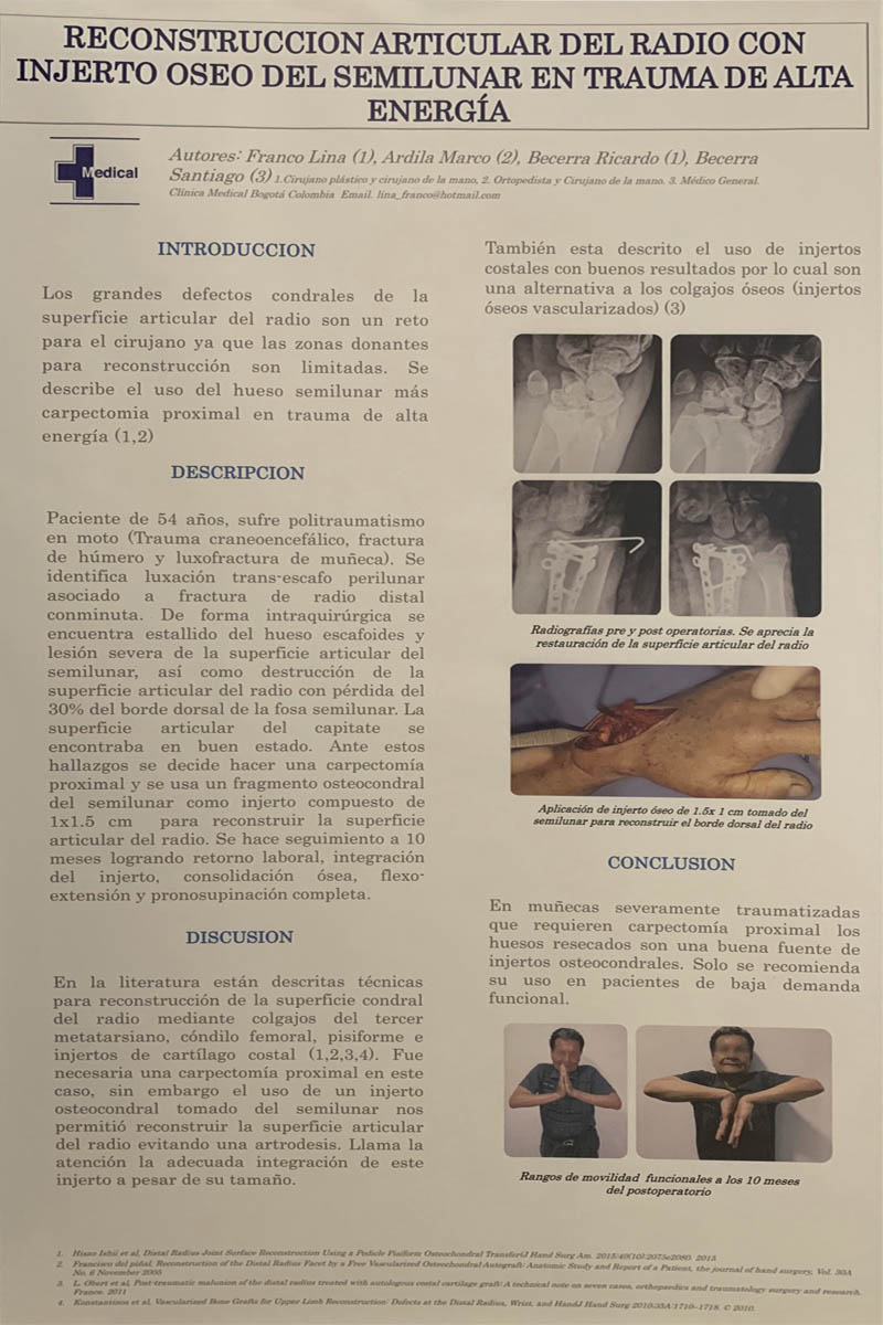 clinica-medical-realiza-la-primera-reconstruccion-articular-de-radio-2